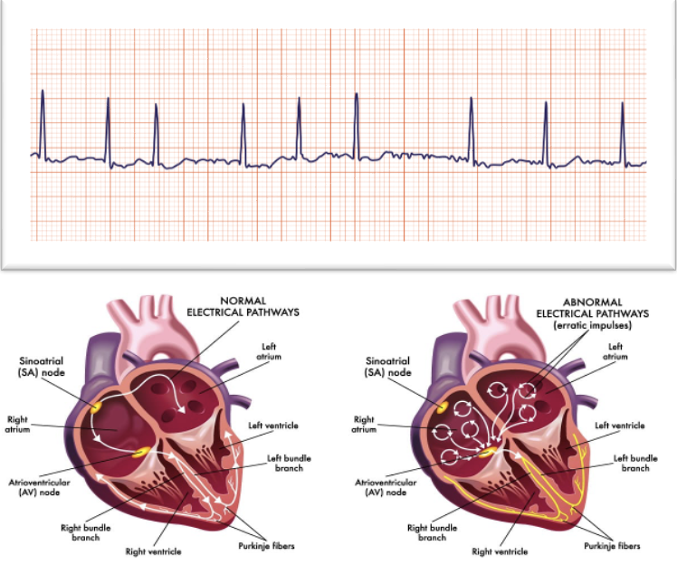 <ul><li><p class=""><strong>Rate</strong>: <em>Atrial</em> — <mark data-color="yellow" style="background-color: yellow; color: inherit">300 to 600 bpm</mark>; <em>Ventricular</em> — Variable, but between <em><u>60 to 100 bpm</u></em></p></li><li><p class=""><strong>Rhythm</strong>: Highly <u>irregular</u></p></li><li><p class=""><strong>P Waves</strong>: No discernible P waves; irregular, undulating waves are referred to as fibrillatory or <em>f</em> waves</p></li><li><p class=""><strong>P to QRS Ratio</strong>: Not discernible</p></li><li><p class=""><strong>PR Interval</strong>: Absent; unmeasurable due to lack of P waves</p></li><li><p class=""><strong>QRS Complex</strong>: Usually normal</p></li></ul><p></p>