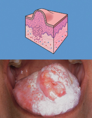 <p>(Solid mass of tissue > 1 cm in diameter)</p>