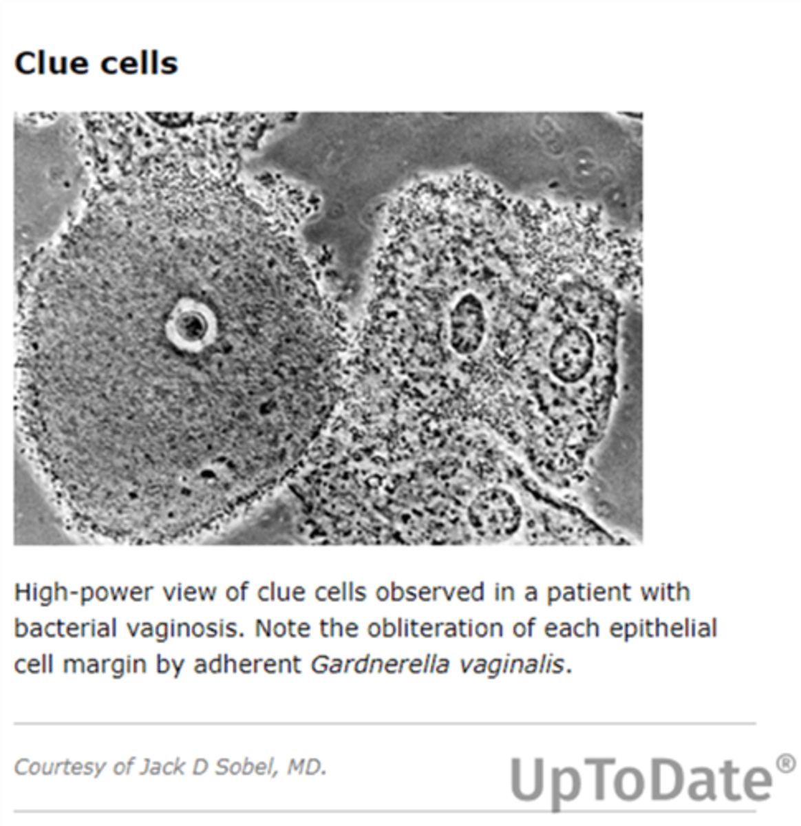 <p>clue cells</p><p>“Ground glass” appearance (pepper on your fried eggs) </p>