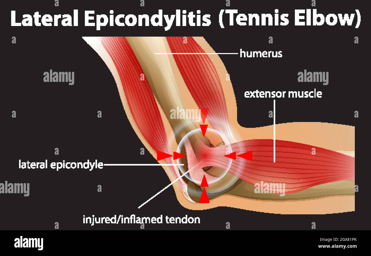 <p>Overuse of *common extensor tendon* at lateral epicondyle → pain on wrist extension. 🎾 Mnemonic: "Lateral pain = tennis strain."</p>