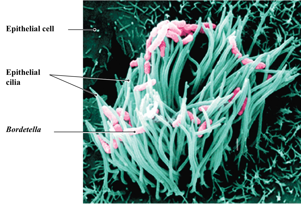 <p>Also known as Pertussis</p><p><span>Agent: </span><em><span>Bordatella pertussis</span></em></p><p><span>Route of Transmission: Inhalation</span></p><p><span>Symptoms: </span><span style="background-color: transparent;"><u><span>Catarrhal stage</span></u><span>: common cold</span></span></p><p><span style="background-color: transparent;"><u><span>Paroxysmal stage</span></u><span>: persistent, violent cough without a breath; wheezing inhalation (whoop)</span></span></p><p><span style="background-color: transparent;"><u><span>Convalescent stage</span></u><span>: several weeks as coughing subsides</span></span><br>- <span>Cyanosis (blue appearance) due to poor oxygen exchange</span></p><p class="s31"><span>-Dangerous to children</span></p><p class="s31"><span>— kills cilia in throat causing build up of mucus </span></p><p></p>