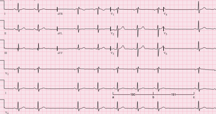 <p>Describe the rhythm of this patient.</p>