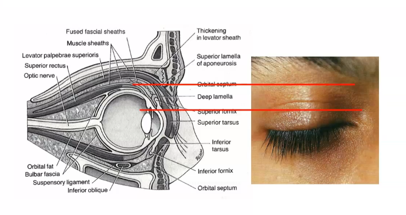 <p>first crease is top of cornea </p><p></p>
