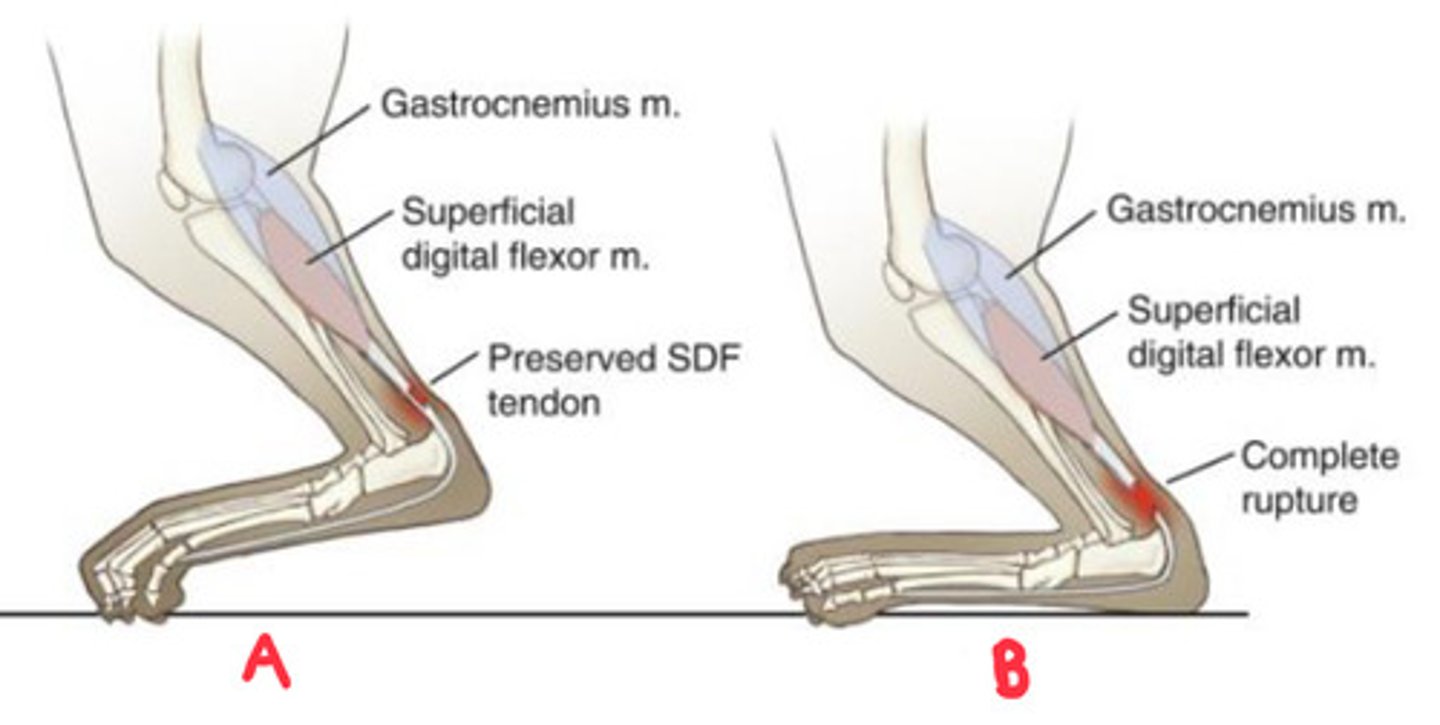 <p>Clinical presentation of partial vs complete achilles tendon rupture?</p>