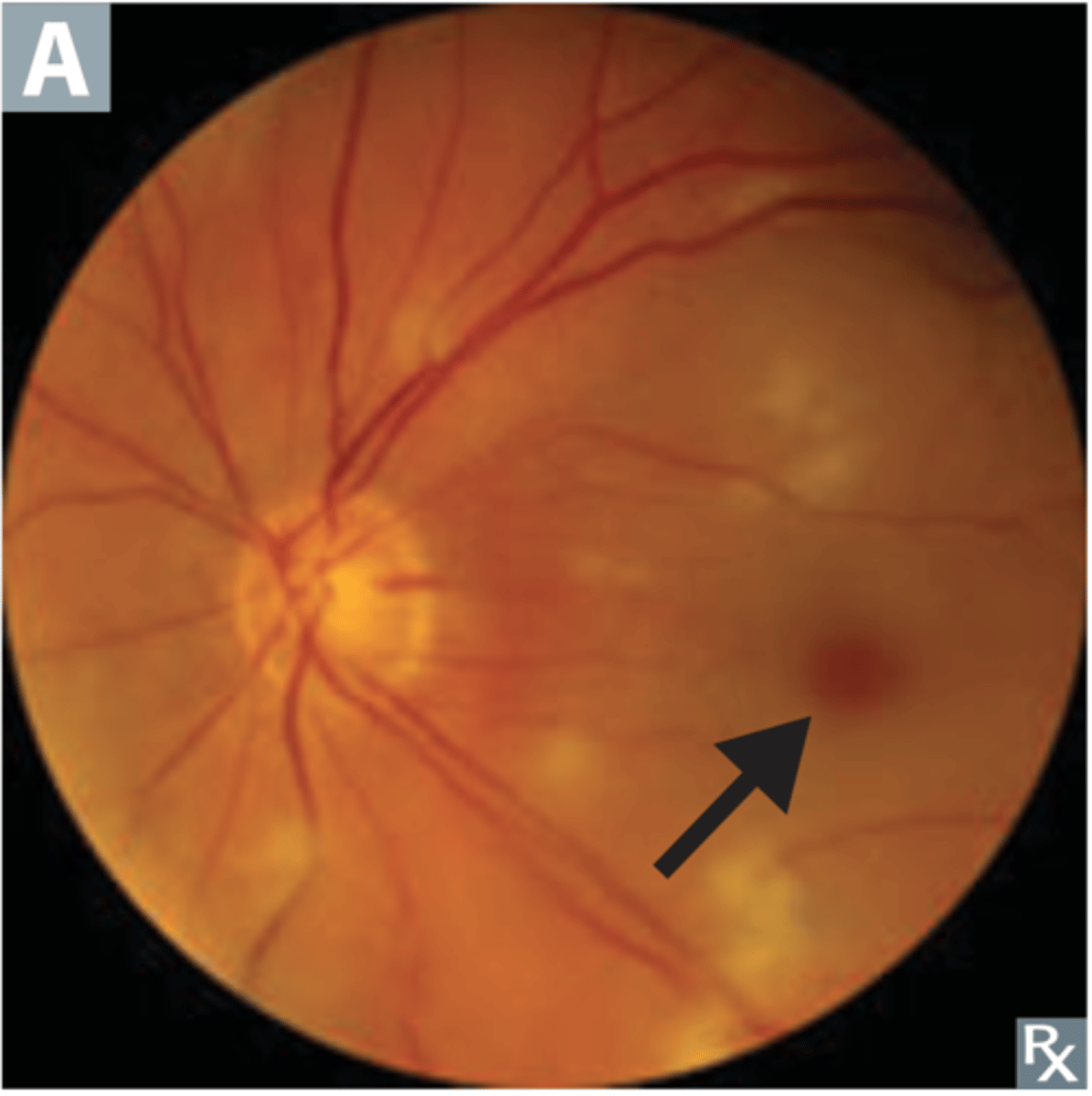 <p>Retinal arterial occlusion can lead to what issues?</p>