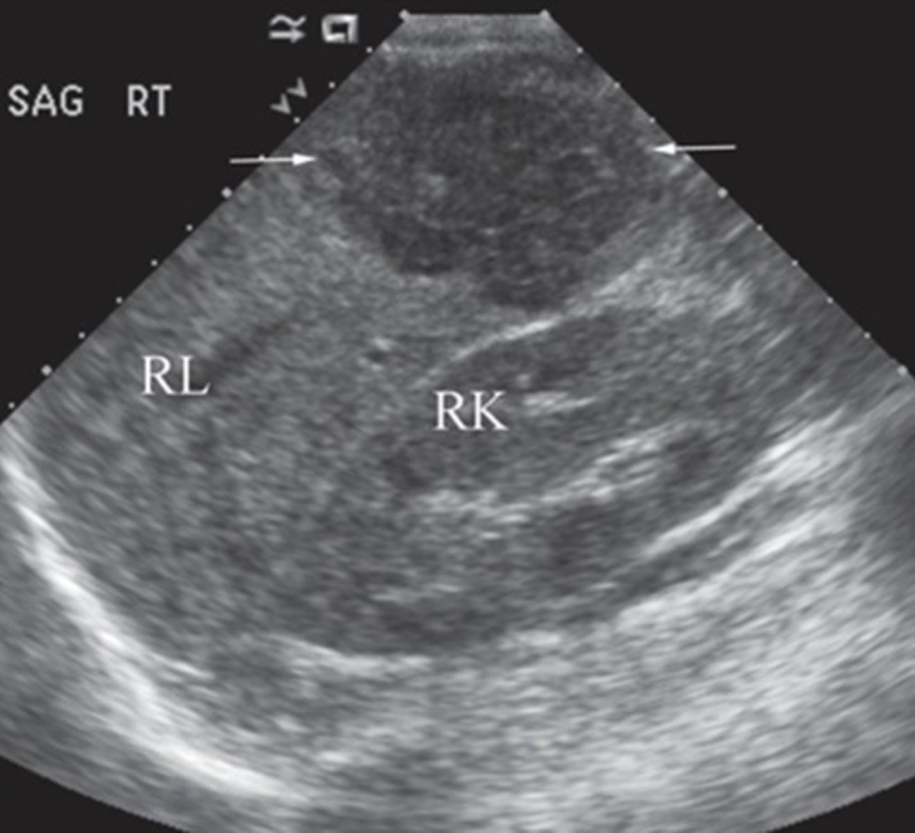 <p>Most common primary liver malignancy (but more rare than liver metastasis)</p><p>Cirrhosis from Hepatitis B or C leads to increased risk</p><p>Solid, inhomogenous, irregular mass</p>