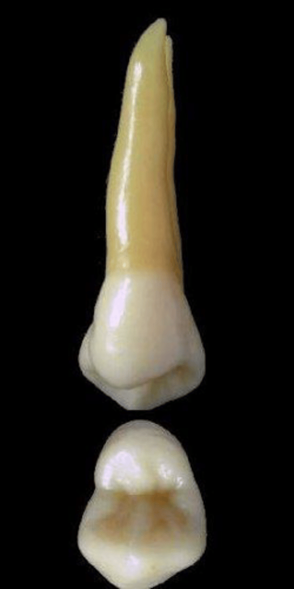 <p>what tooth is this &amp; why?</p>
