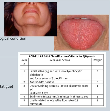 <p><em>Not all dry mouths are Sjogren’s Syndrome </em></p><p><u>Primary </u>– de novo occurrence</p><p><u>Secondary </u>– Preceded by another rheumatological condition </p><ul><li><p> Symptoms – Oral and ocular dryness </p></li><li><p>Extra-glandular features </p><ul><li><p>MSK (Distal joint pain and myalgia)</p></li><li><p>Skin (Dryness, rashes and vasculitis) </p></li><li><p>Lungs (Interstitial lung disease) </p></li><li><p>GI (Swallowing difficulties, pancreatitis) </p></li><li><p>Nervous system (Peripheral neuropathy, fatigue)</p></li><li><p>Renal (interstitial nephritis) </p></li></ul></li><li><p>Antibodies – Ro60 and La</p></li></ul><p></p>