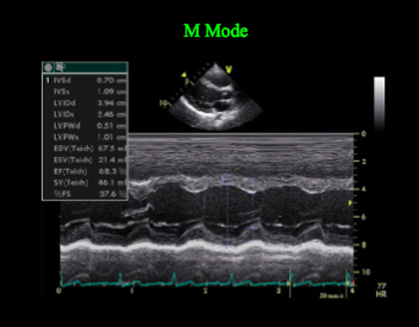 <p>Produces one-dimensional information on a time-motion graph,</p><p>Displayed along a line representing the ultrasound beam direction ( provides a single line of information at a higher frame rate)</p><p>Temporal and spatial resolutions are higher because the focus is on only one of the lines from the 2D trace</p>