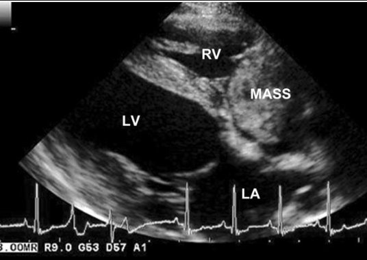 <p>-to identify mass in right atrium or appendage</p><p>-pericardial effusion improves detection of mass (SP=100%, SN=82%)</p>