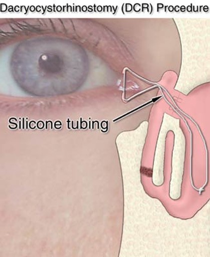 <ul><li><p><span><strong>Dacryocystorhinostomy </strong></span></p><ul><li><p><span>Hole drilled into <strong>nasal </strong>cavity - silicone tube inserted to maintain drainage</span></p></li></ul></li></ul><p></p>