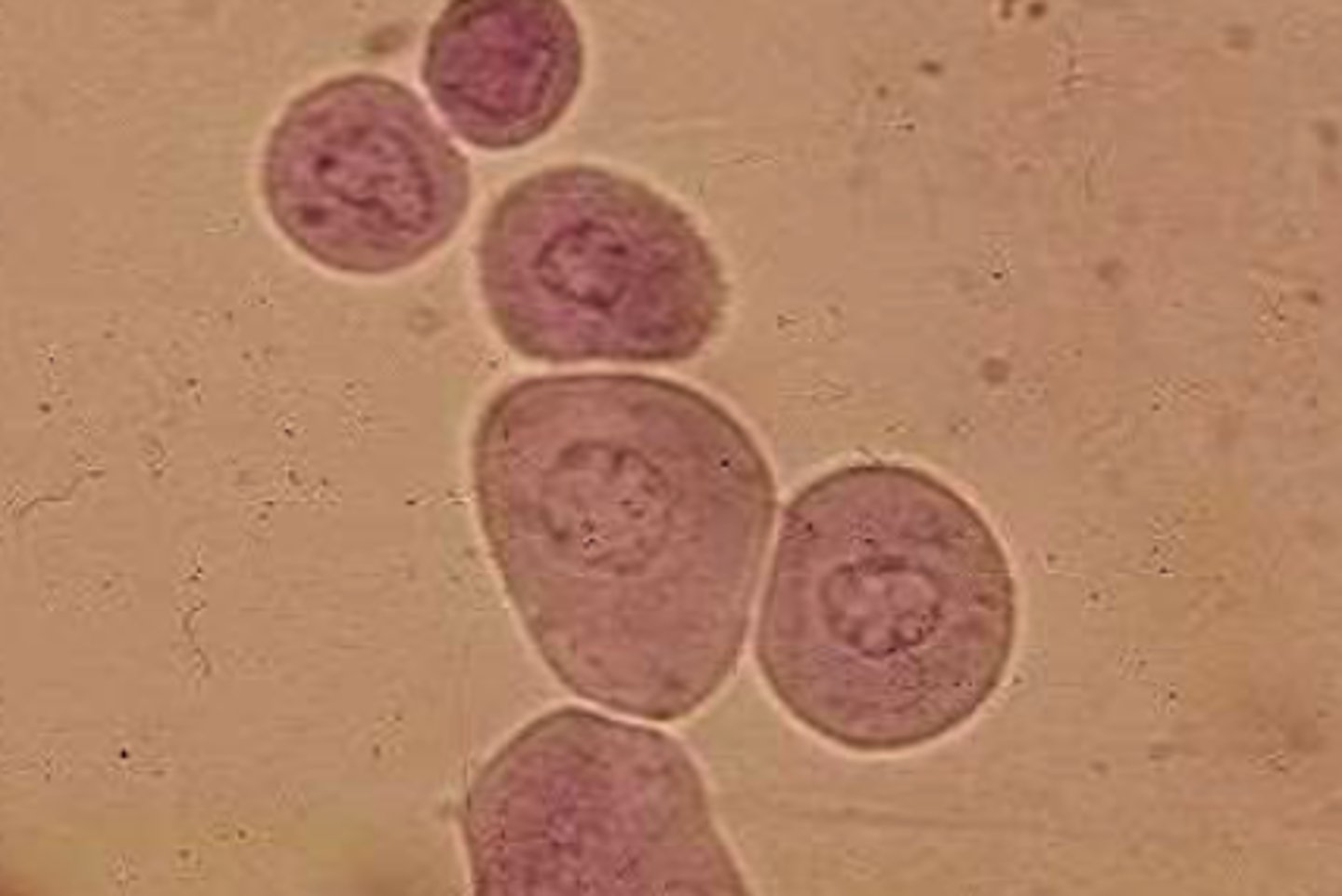 <p>- Originates from bladder, ureters, renal pelvis, or proximal urethra</p><p>- Round or pear shaped</p><p>- Granular appearance</p><p>- Larger nucleus</p>