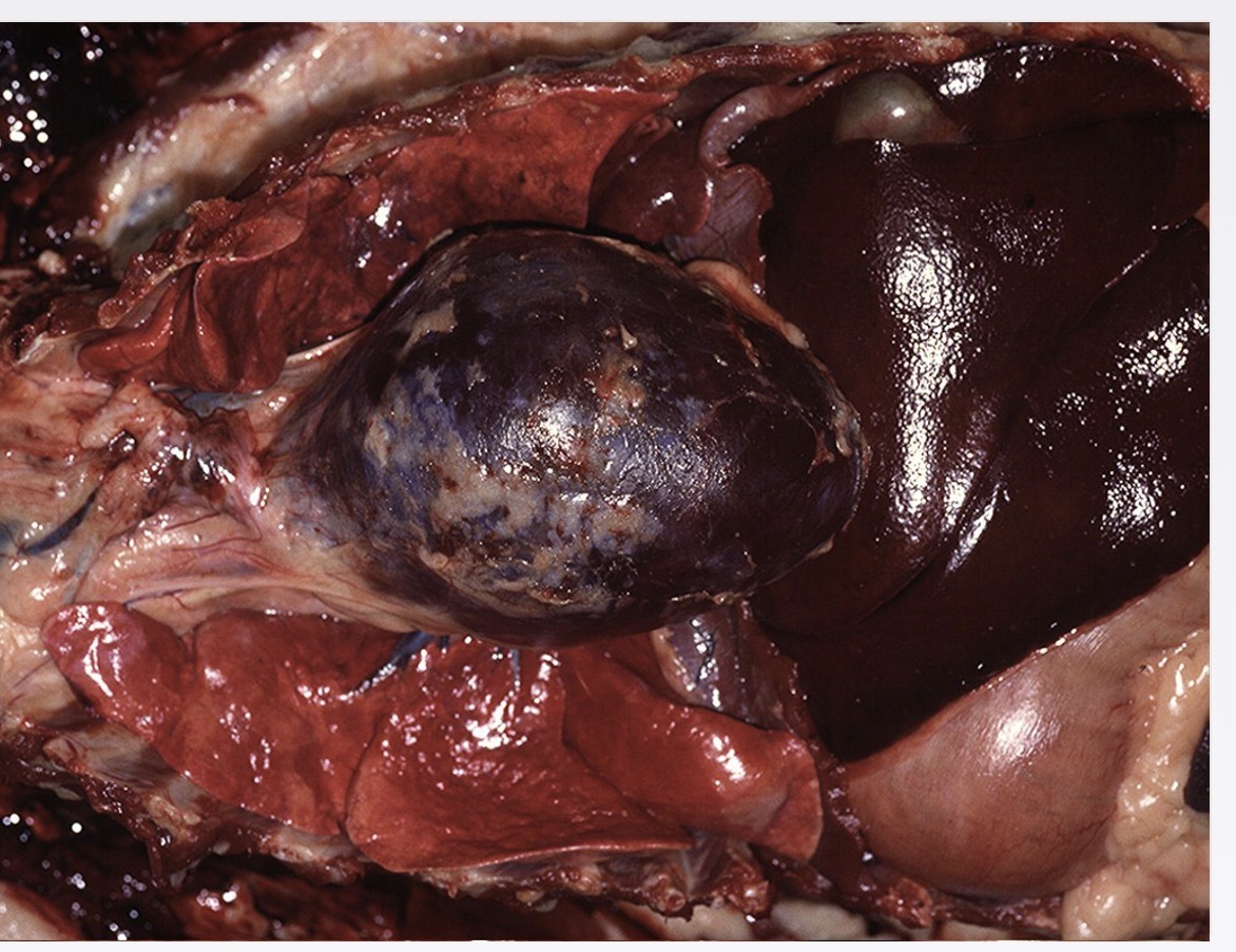 <p>pericardial diseases- haemopericardium effects</p>