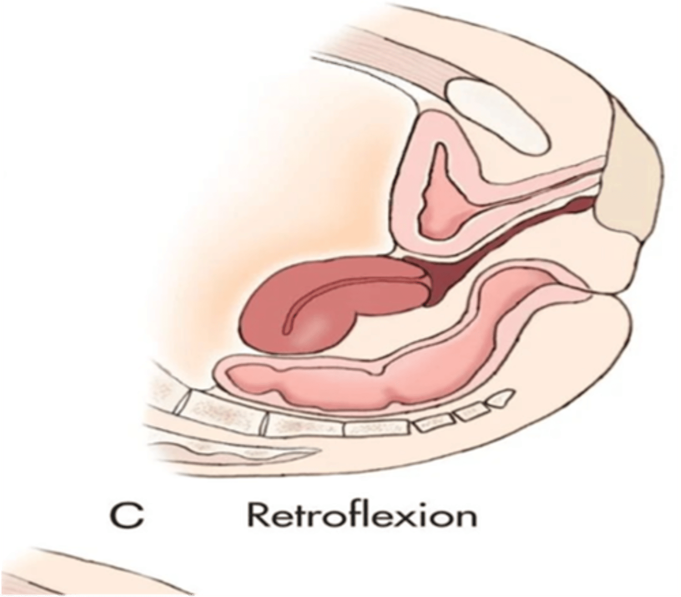 <p>What is a retroflexed uterus?</p>