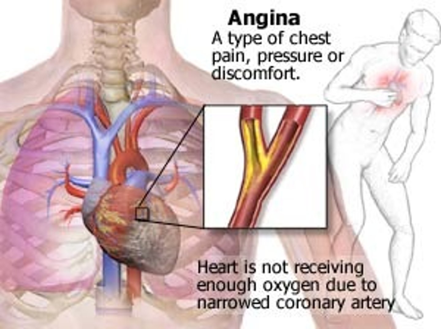 <p>chest pain that results when the heart does not get enough oxygen</p>