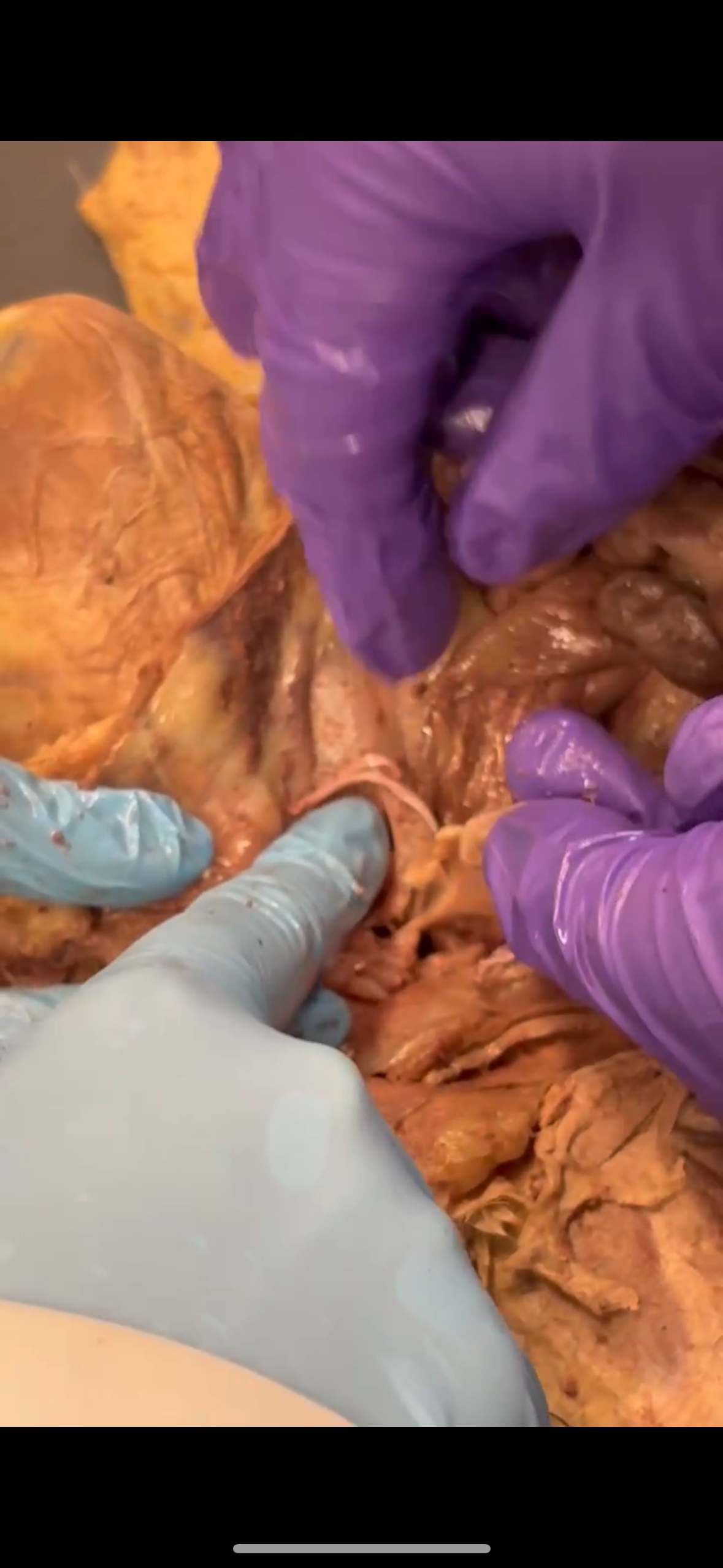 <p>Light blue right finger points to (white line)</p>