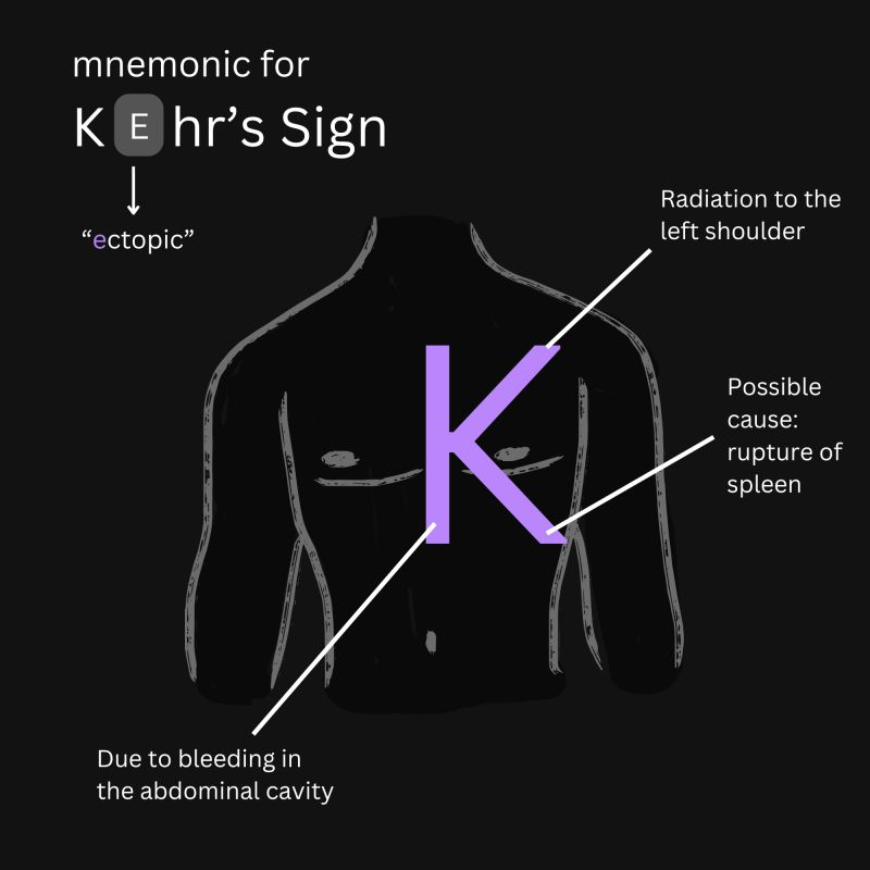 <p>Pain at the tip of the left shoulder</p><ul><li><p>Intra-abdominal bleeding affecting the spleen</p></li><li><p>Blood or other fluid enters the peritoneal cavity, irritating diaphragm and then the shoulder</p></li><li><p><u>Kehr-bear</u> gives a hug on top of shoulder→ah! my spleen! </p></li><li><p>OR: Imagine a K on the patient. One line radiates the shoulder. One line goes the to spleen.</p></li></ul><p></p>