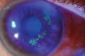 <p>Herpetic Keratitis </p>