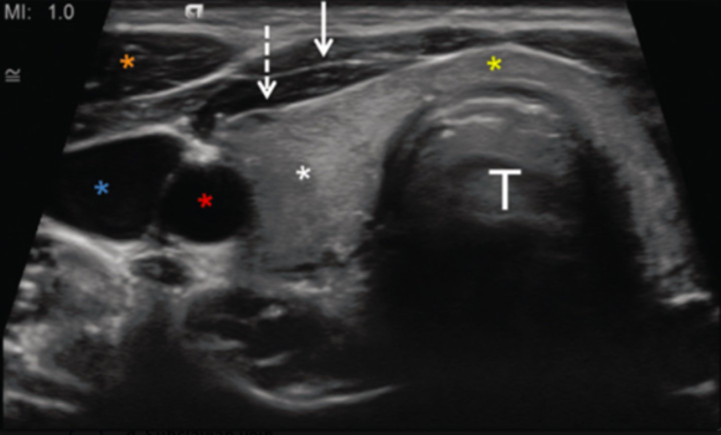 <p>a. Common carotid artery</p>
