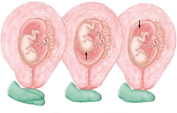 <p>When the baby is tapped, the baby bounces on the uterine wall and then bounces back.</p>