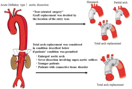 <p>What does this refer to </p><ul><li><p>Objective is often to resect (remove) the most severely damaged segments of the aorta, and prevent entry of blood into the false lumen</p><ul><li><p>Graft inserted post resection</p><p></p></li></ul></li></ul><p></p>