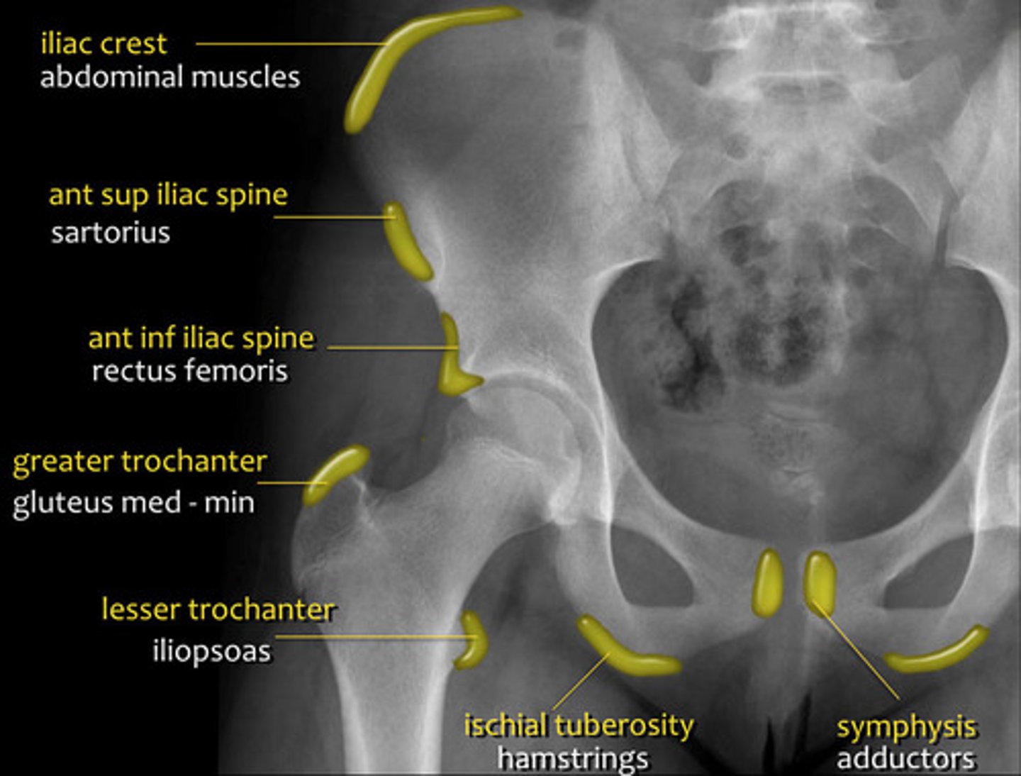 <p>-ASIS (ANTERIOR SUPERIOR ILIAC SPINE)- SARTORIUS</p><p>-AIIS (ANTERIOR INFERIOR ILIAC SPINE) - RECTUS FEMORIS</p><p>-GREATER TROCHANTER - GLUTEUS MEDIUS AND MINIMUS</p><p>-LESSER TROCHANTER - ILIOPSOAS</p>