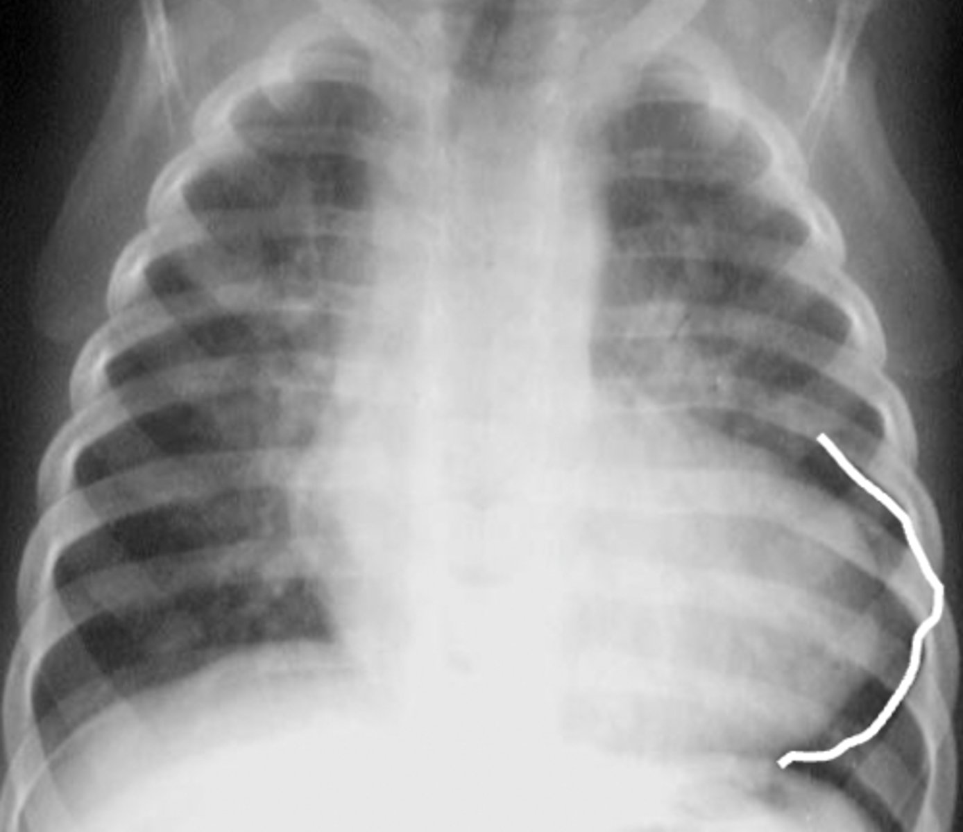 <p>notice how the apex of the heart appears elevated or "picked up"</p>