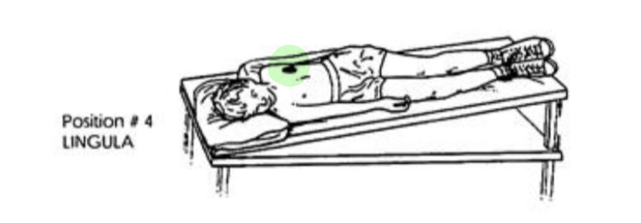 <ul><li><p>Right Side Lying</p></li><li><p>Head Down 15 degrees</p></li><li><p>¼ Turn Backwards </p></li></ul><p></p><p>NOTE:</p><ul><li><p>FOR L LUNG » Only L Lung had Lingula</p></li></ul><p></p>