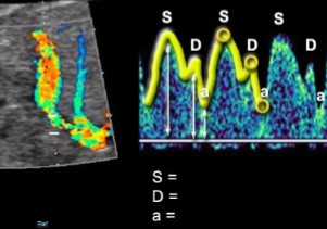 <p>The ductus venosus was dopplered, label what the SDa stands for on the waveform. </p>