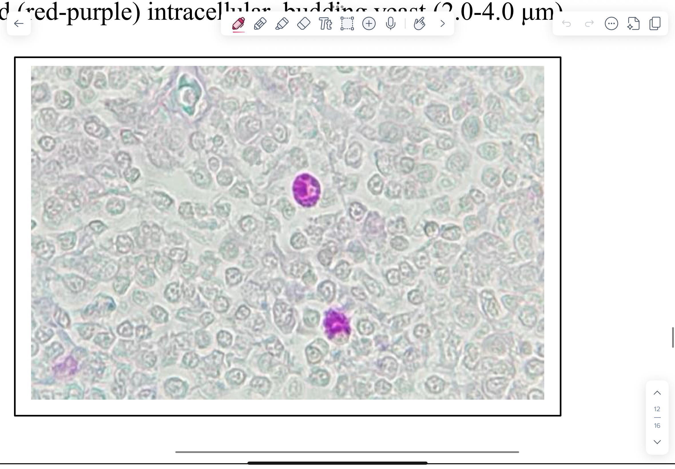 <p>NOTE small, light stained (red-purple) intracellular, budding yeast (2.0-4.0 μm).</p>