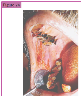 <p>__________________ of teeth and ______________ of the buccal mucosa in a patient with a habit of chewing pan.</p>
