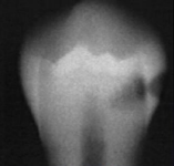 <p>classify this according to radiographic presentation of the ADA </p>