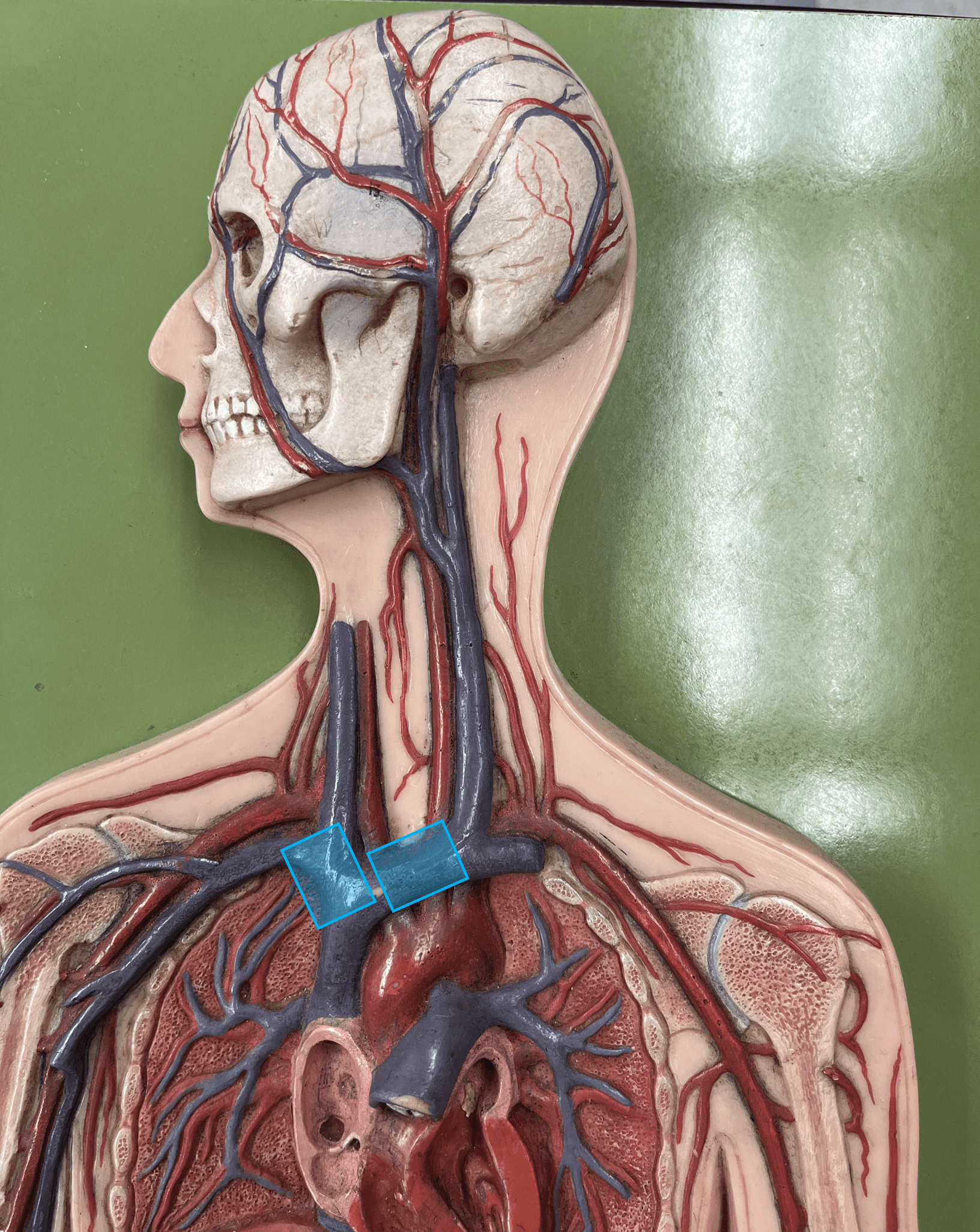 <p>• A vein of the thorax.</p>
<p>• Drains the subclavian, external jugular, vertebral, internal jugular, and left intercostal (1-3) veins.</p>
<p>• Empties into the superior vena cava.</p>