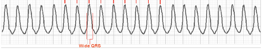 <p>__ has an EKG showing wide QRS complexes at rates greater than 120 bpm with at least __ in a row. </p>