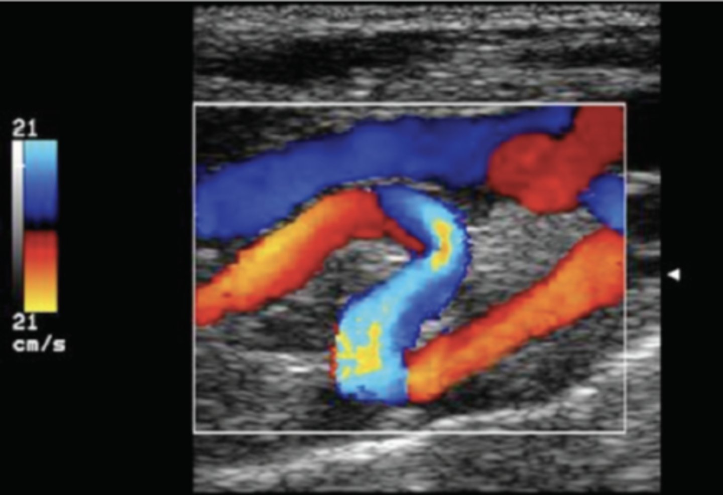 <p>Doppler frequency shift exceeds Nyquist limit (max detectible frequency)</p><p>"Wrap-around" color display</p><p>Seen with high velocity/turbulent areas & stenosis</p>