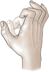 <p>lower brachial plexus injury, affects lower arm: hand on up</p>