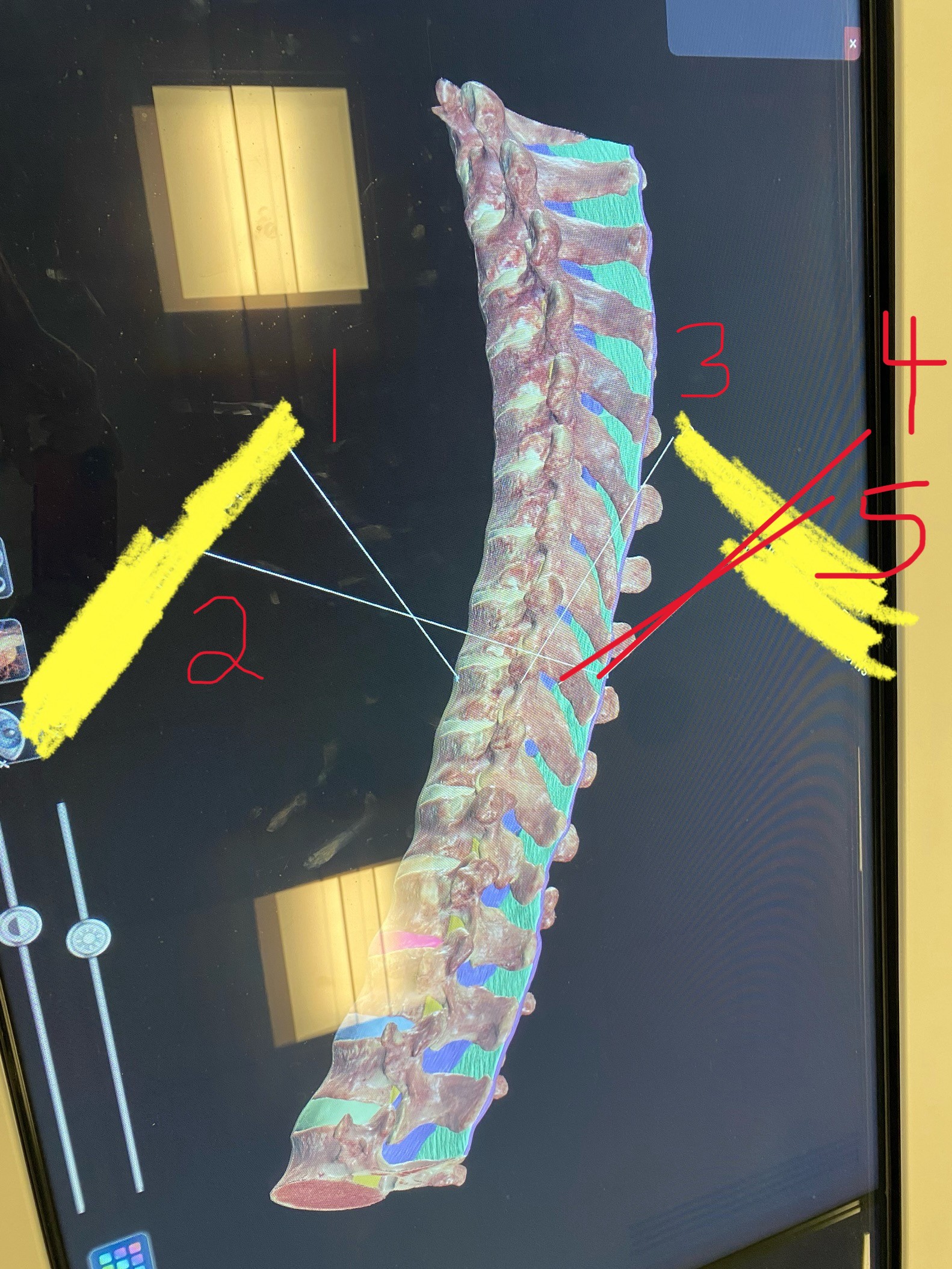 <p>What spinal ligament is number 3</p>