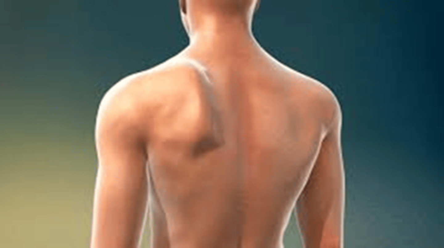 <p>Horner's syndrome</p><p>hoarseness due to CN X lesion</p><p>droopy shoulder due to sternocleidomastoid issue</p><p>winged scapula due to trapezius issue</p><p>cannot say "La" due to CN XII lesion</p>