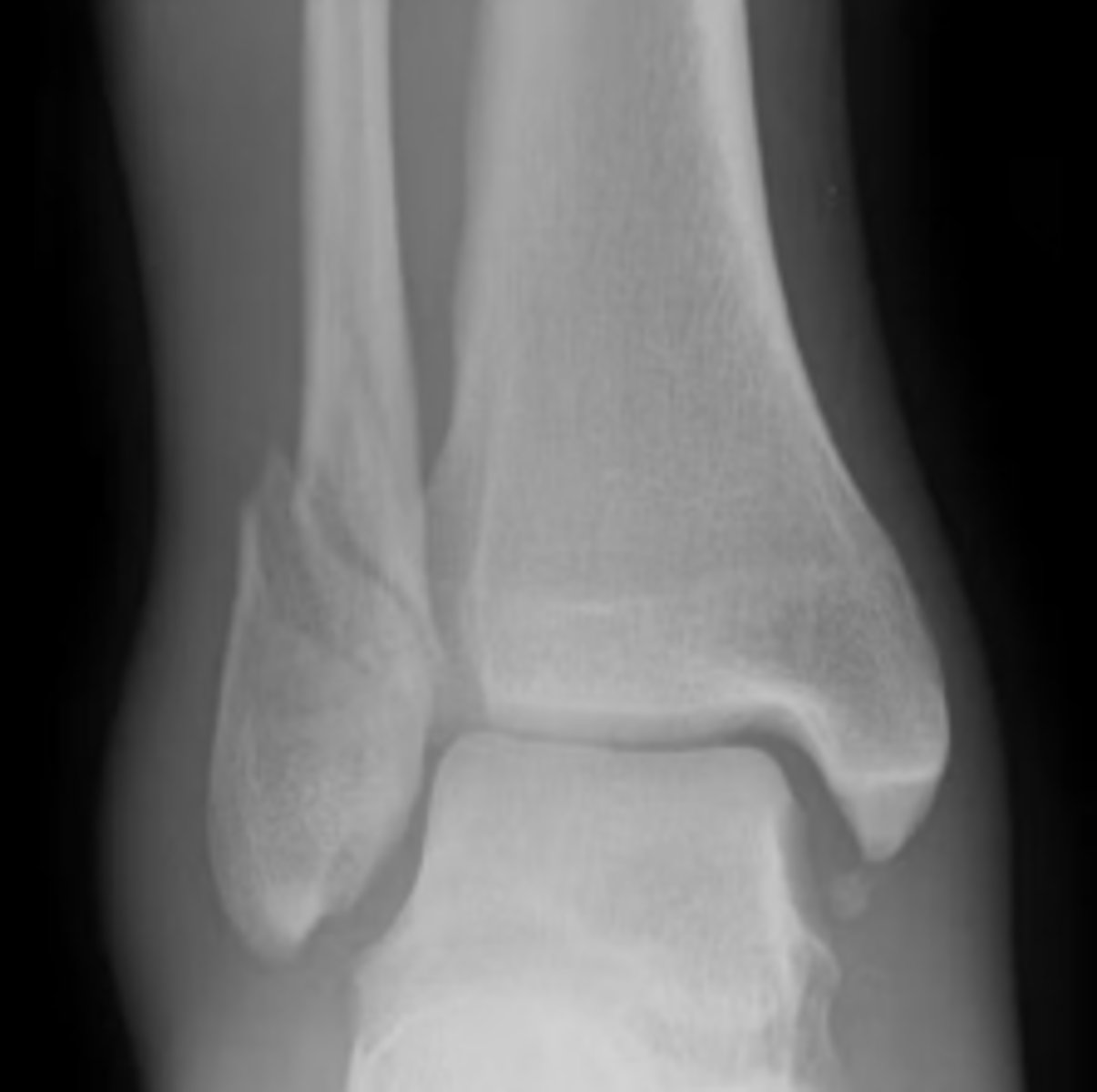 <p>Type B</p><p>At the level of the syndesmosis </p>