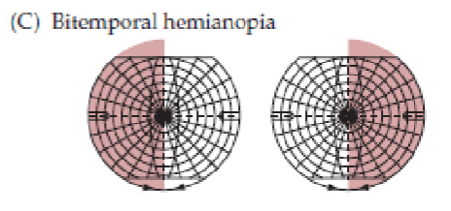 <p>Bitemporal hemianopia</p>