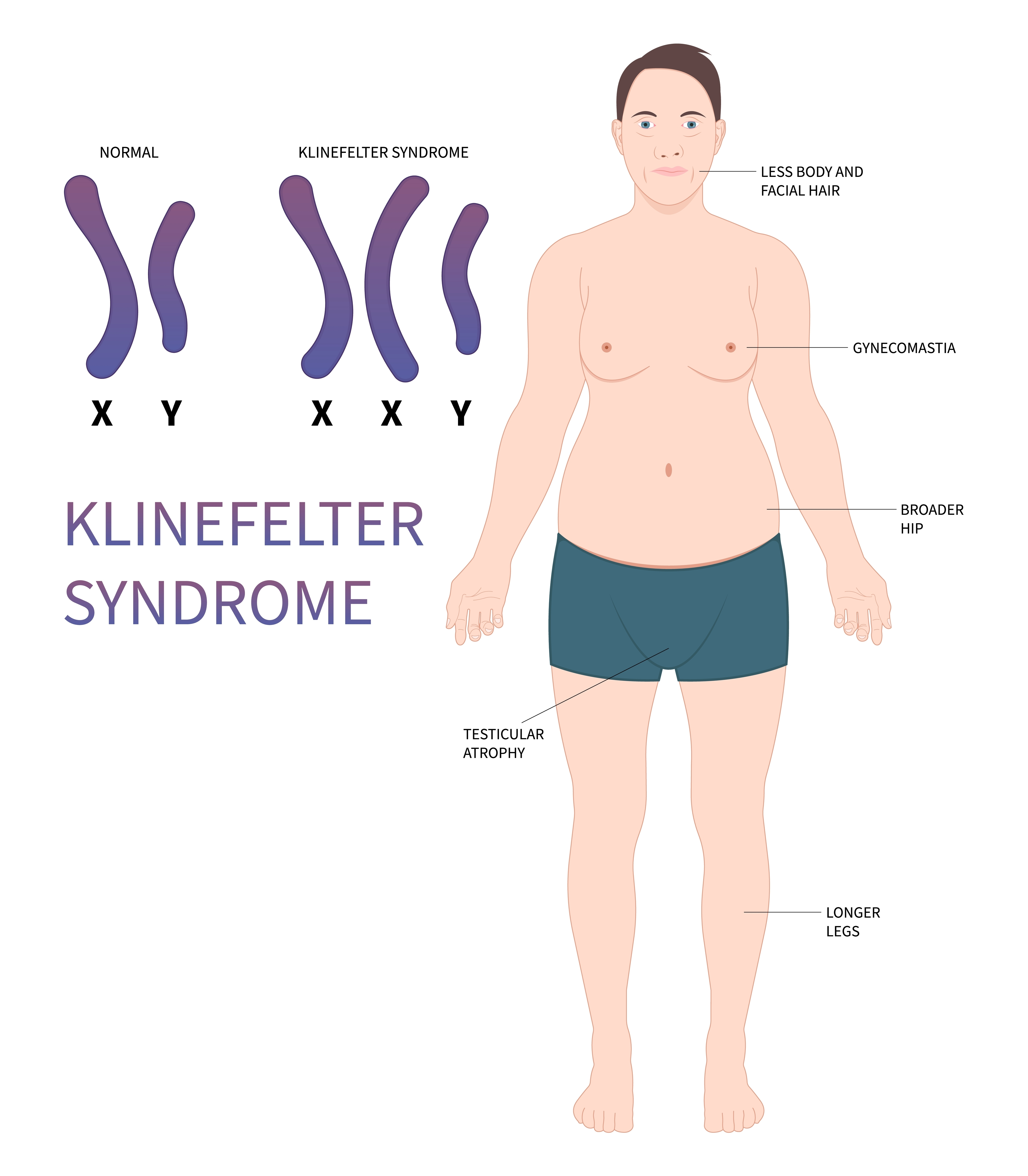 <ul><li><p>Reduced facial hair</p></li><li><p>Tall, thin physique</p></li><li><p>Small, infertile testes</p></li><li><p>Development of breast tissue at puberty</p></li></ul><p></p>