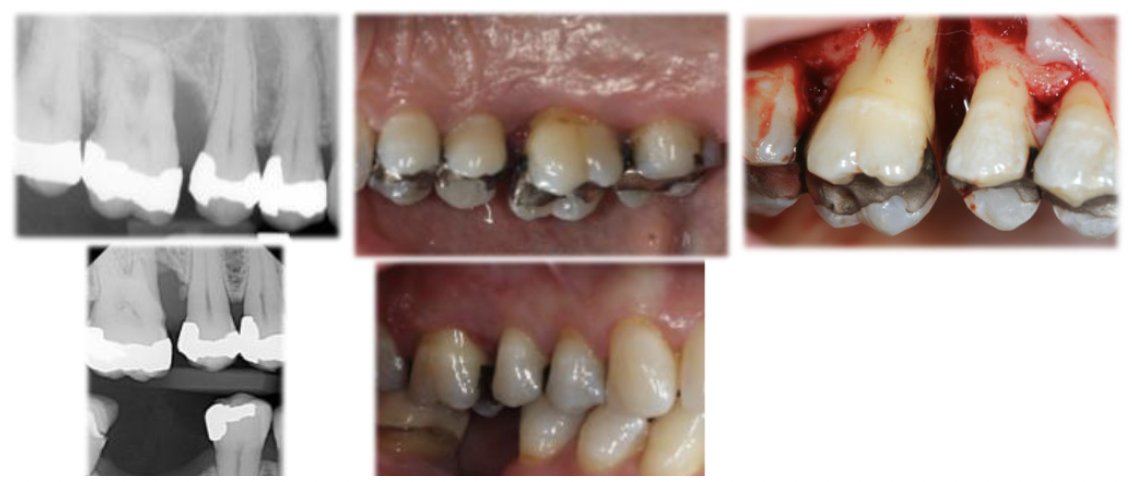 <p>Open (Role of food impaction?)</p>