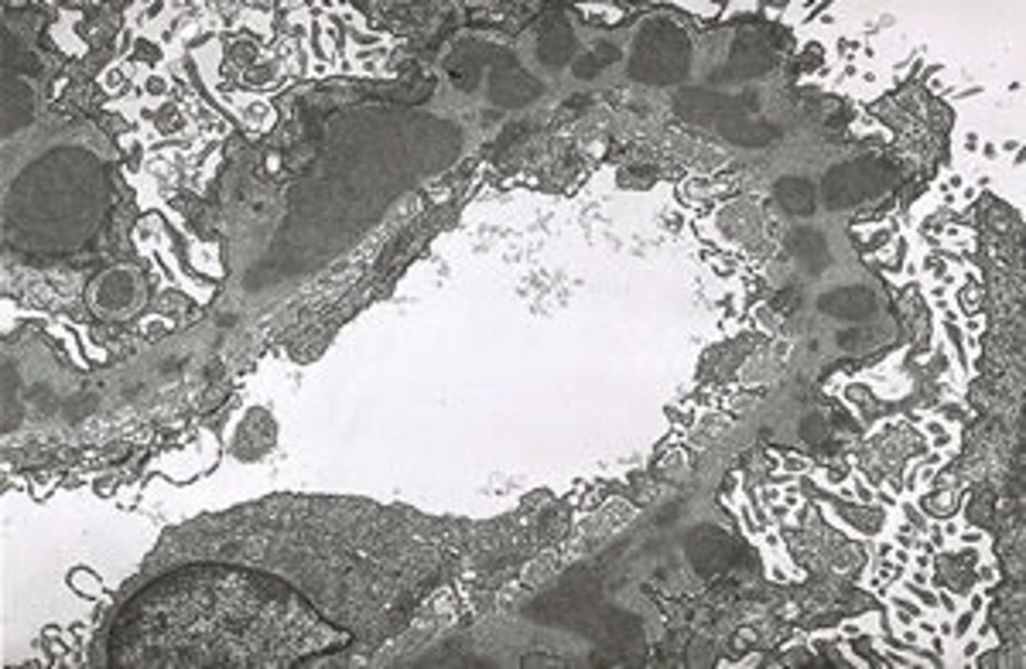 <p>D. immune complexes</p><p>The electron micrograph shows electron-dense subepithelial immune complex deposits, they appear within and on the outer aspect of the glomerular basement membrane. Lysosomes and mitochondria do not accumulate within the basement membrane.</p>
