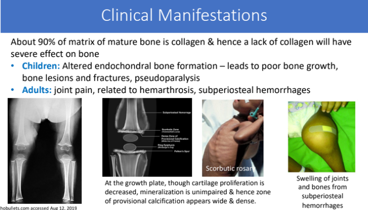 <p>joint pain, related to hemarthrosis, subperiosteal hemorrhages </p>