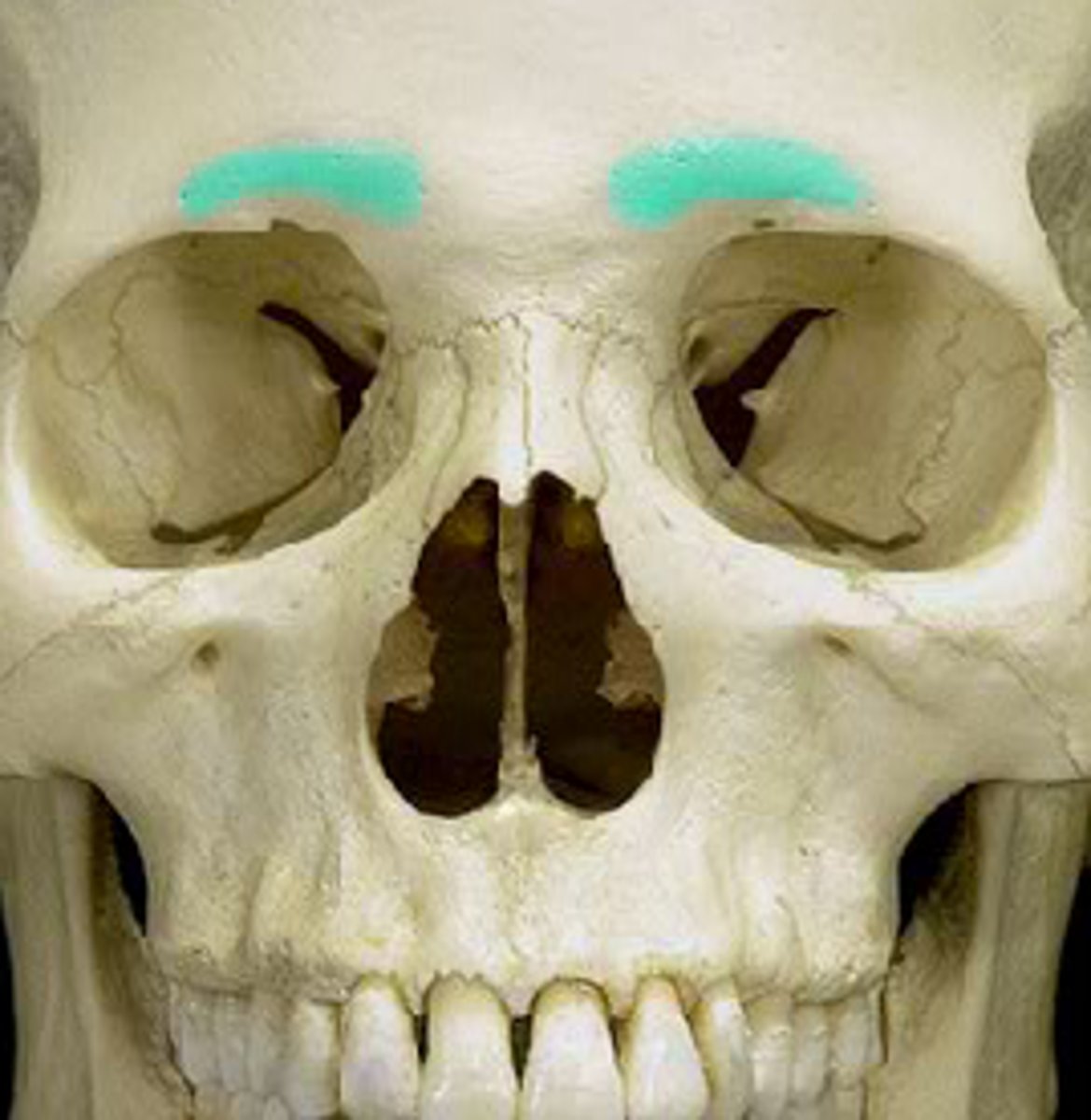 <p>the ridge above the eye socket indicating the location of the frontal sinus</p>