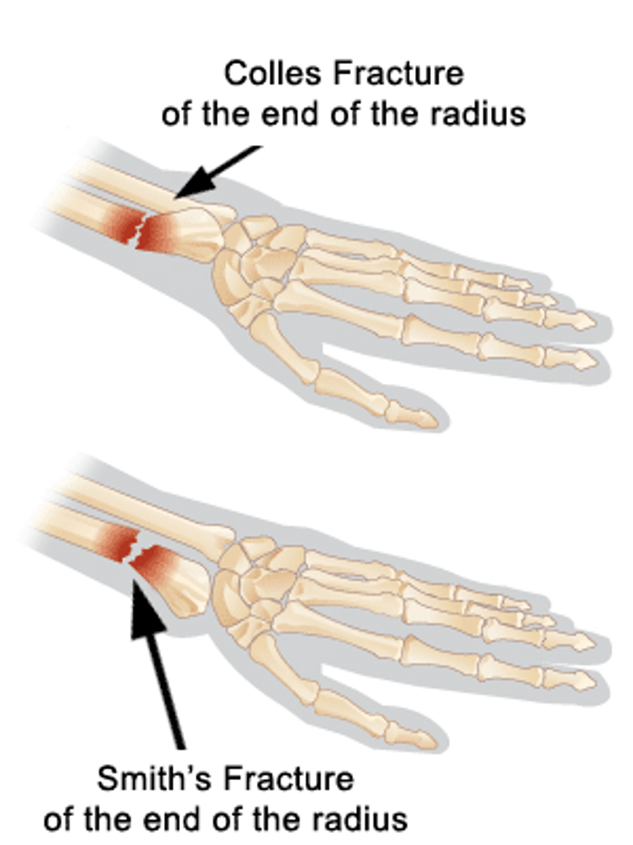 <p>distal radius is broken by falling onto an outstretched hand</p><p>Most common form of wrist</p><p>fracture from FOOSH injury</p><p>Distal radius displaced dorsally</p>