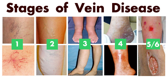 <p>Which numbers indicate severe venous disease? </p>