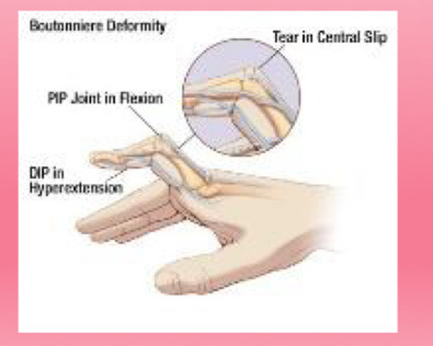 <p>Flexion of the PIP joint + hyperextension of the DIP joint.</p>