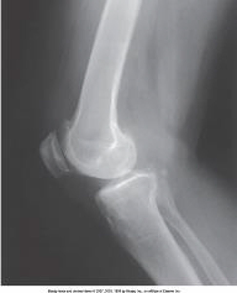 <p>What is the central-ray direction needed to produce the image below?</p><p>Perpendicular</p><p>3 to 5 degrees cephalic</p><p>5 to 7 degrees cephalic</p><p>10 degrees cephalic</p>