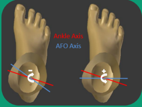 <p>Pressure concentration on the medial surface of the foot during gait </p>